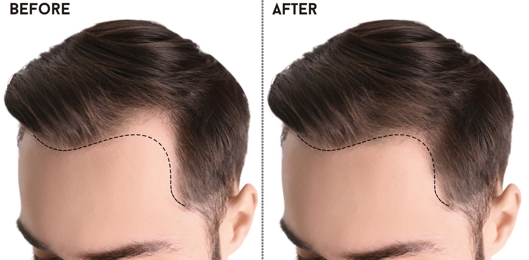 Before-and-after-a-hairline-transplant